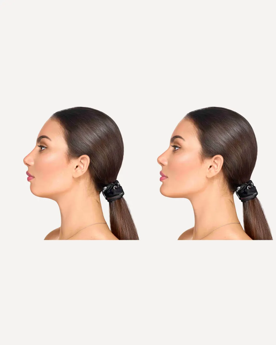 Advanced Facial Contouring with Chin Augmentation at Cinch Clinics